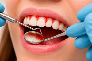 Sangrado de encías.